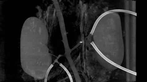 Tiny device spins blood clots away [video]