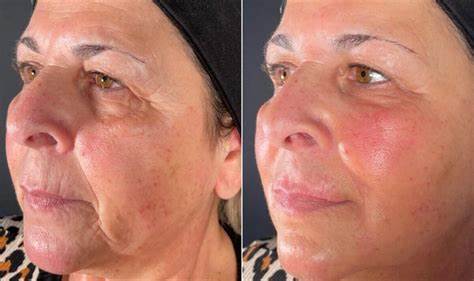 A 70-Year-Old Man's Search for Younger-Looking Skin