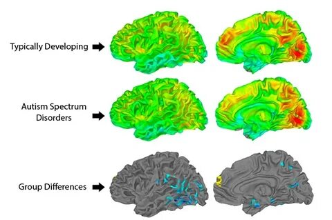 Noninvasive reduction of neural rigidity alters autistic behaviors in humans