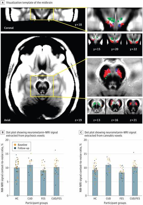 Convergence of Cannabis and Psychosis on the Dopamine System