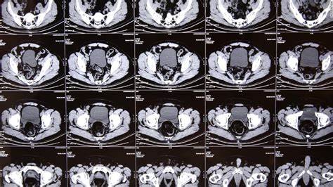 CT Scans Could Be Triggering an Alarming Number of Cancer Cases