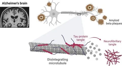Alzheimers: Role of tanycytes in formation of tau tangles, amyloid beta plaque