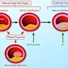 High-volume exercise tied to increased coronary artery calcification score