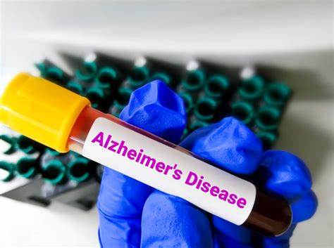 FDA Clears First Blood Test to Diagnose Alzheimer's
