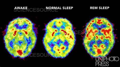 Sleep apnea during REM sleep linked to memory-related brain changes