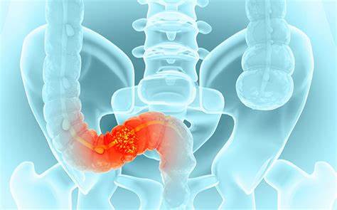 Study suggests a new prescription for colon cancer patients