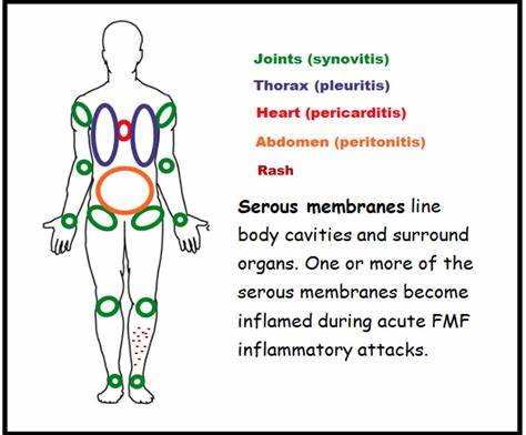 Unexpectedly high prevalence of familial Mediterranean fever in Slovakia