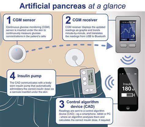 Alabamian with diabetes built her own artificial pancreas, gives away plan