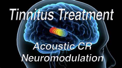 Tinnitus Neuromodulator – Free Tinnitus Masker