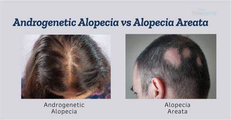 Androgenic alopecia may protect men vs prostate cancer by increasing UV exposure