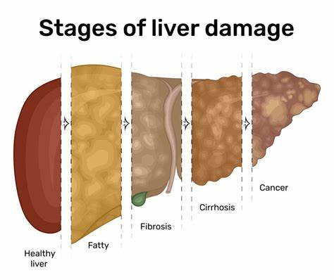 Millions in west don't know they have aggressive fatty liver disease, study says