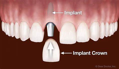 Augmentation / Replacement
