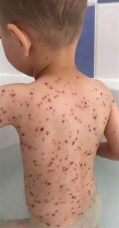 How soon after chickenpox can my son go back to school?