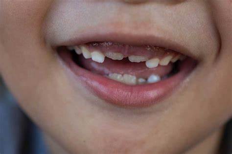 FDA moves to ban fluoride supplements for kids, removing a key tool for dentists