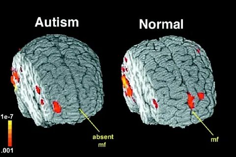 Noninvasive reduction of neural rigidity alters autistic behaviors in humans