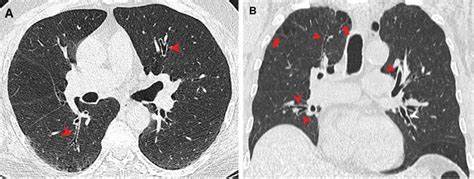 CT scans don't lie–cigarettes are harder on the lungs than marijuana