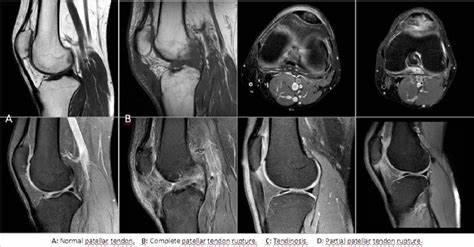 Structural knee MRI findings are already frequent in general population at 33
