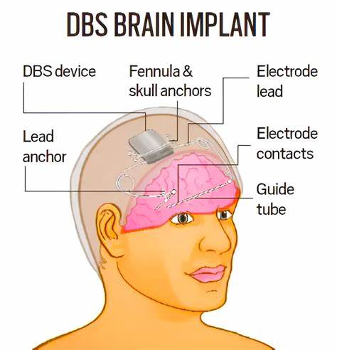 World first: brain implant lets man speak with expression – and sing
