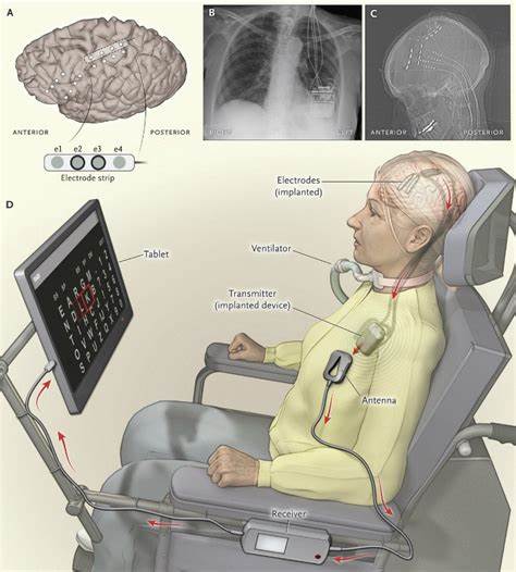 Brain interface allows speech decoding in ALS patient