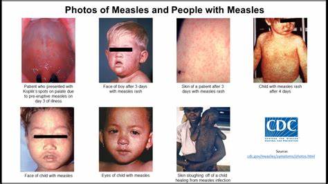 Measles leaves children vulnerable to other diseases for years