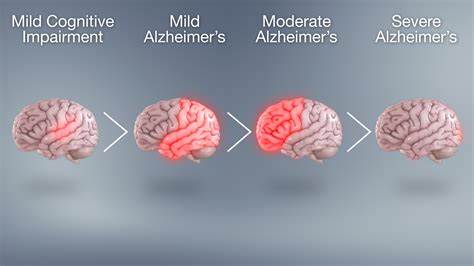 Alzheimer