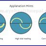 Closed-eye pressure and movement monitoring via contact lens