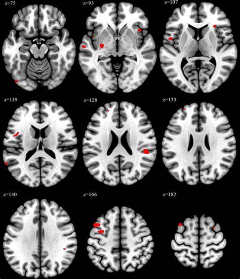 Overwork and changes in brain structure: a pilot study