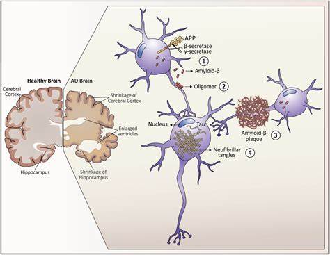 Studie zeigt Ähnlichkeiten in der Proteinstruktur bei Alzheimer und Down-Syndrom
