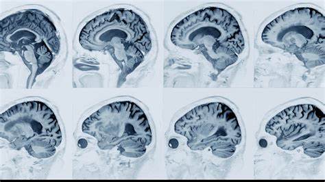 Alzheimers could be linked to a common virus