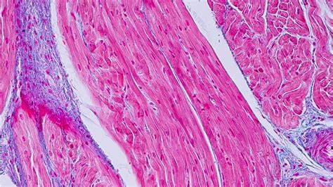 Patient dies in trial of Rocket gene therapy for heart condition